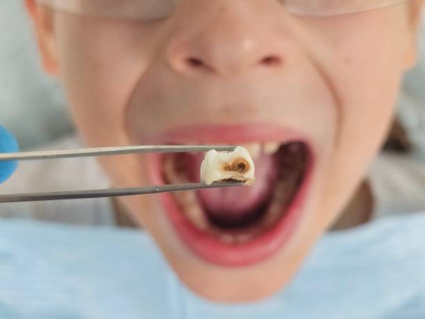 Best Emergency Wisdom Teeth Removal in Sharpsburg, NC